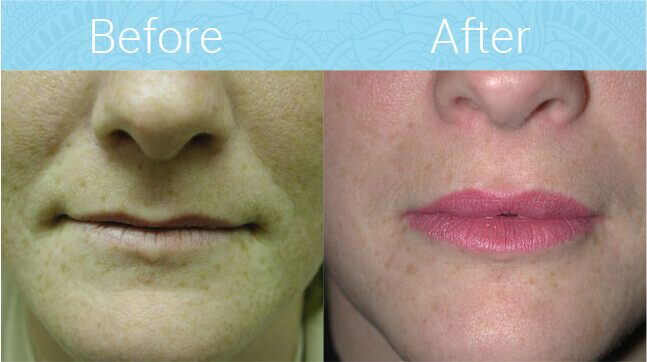 Botox and Costmetics Fillers Before & After
