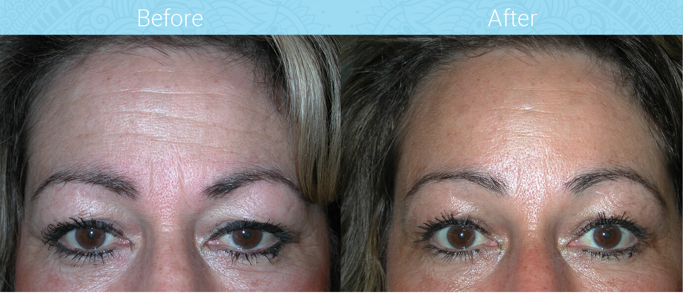 Brow Lift Before & After